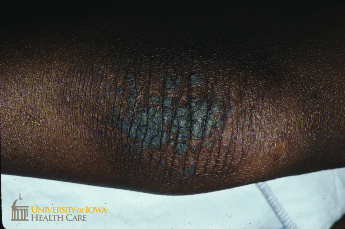 Hyperpigmented papules on the elbows. (click images for higher resolution).